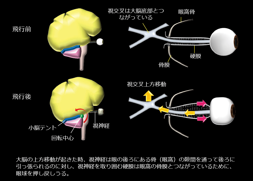 図表２　宇宙飛行士の眼病発症のメカニズム